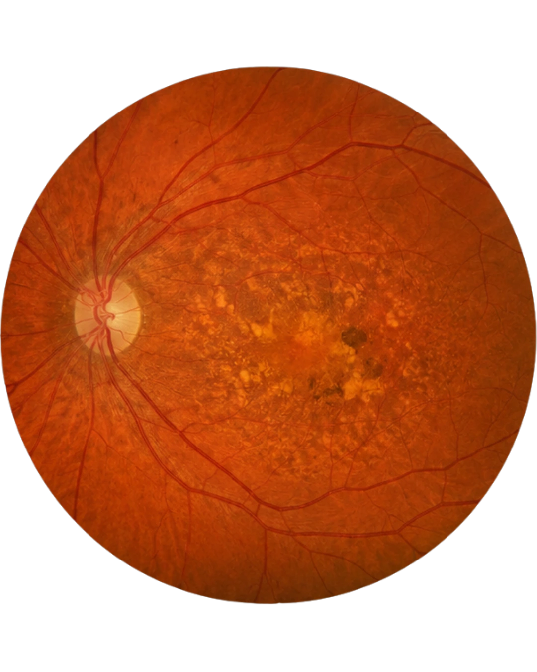 Age-Related Macular Degeneration