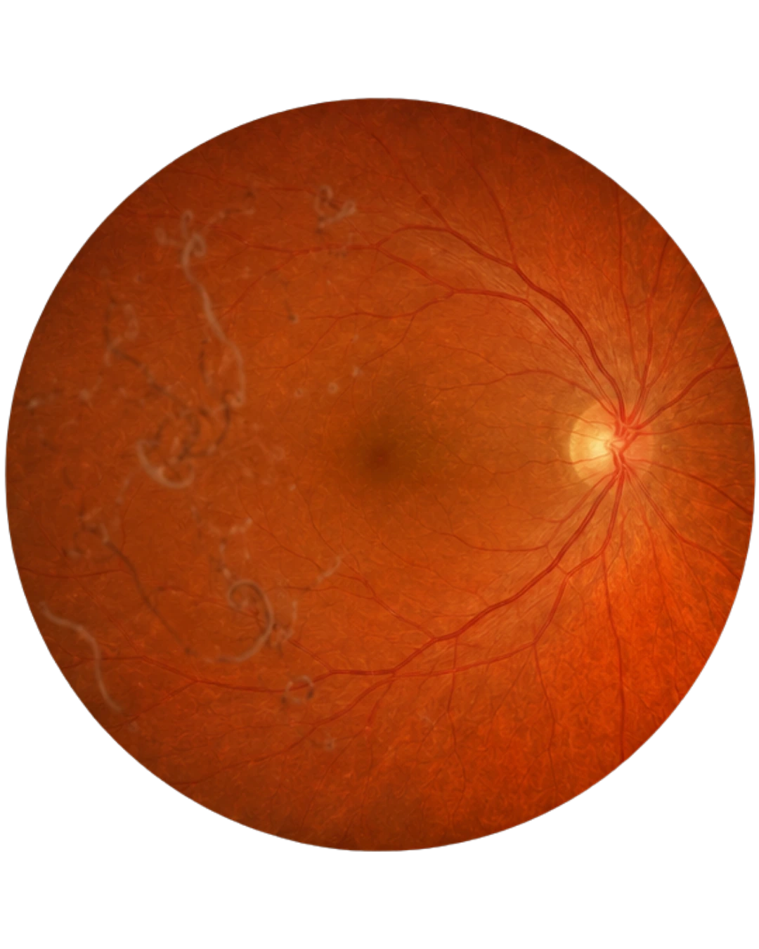 Eye Floaters