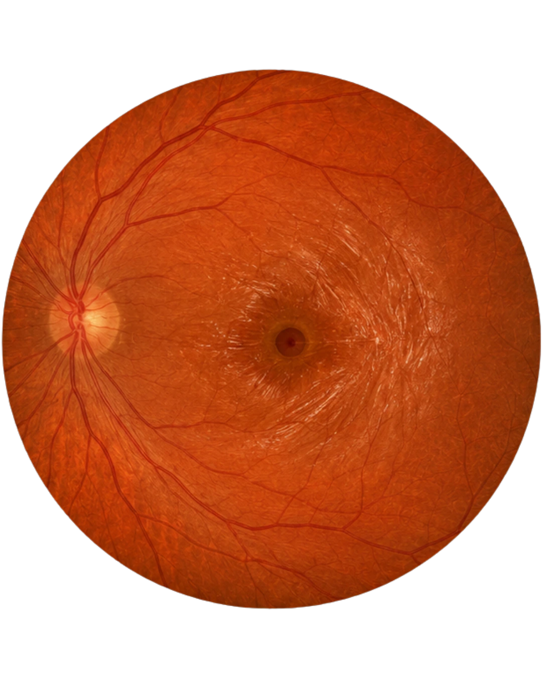 Macular Hole & Epiretinal Membrane