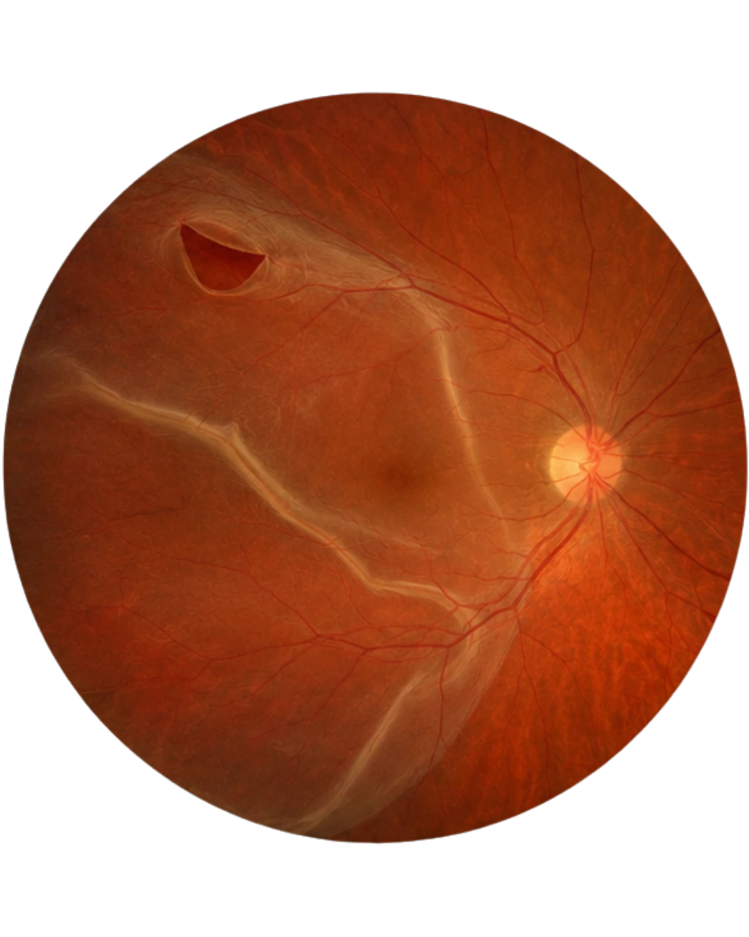 Retinal Tears & Detachment